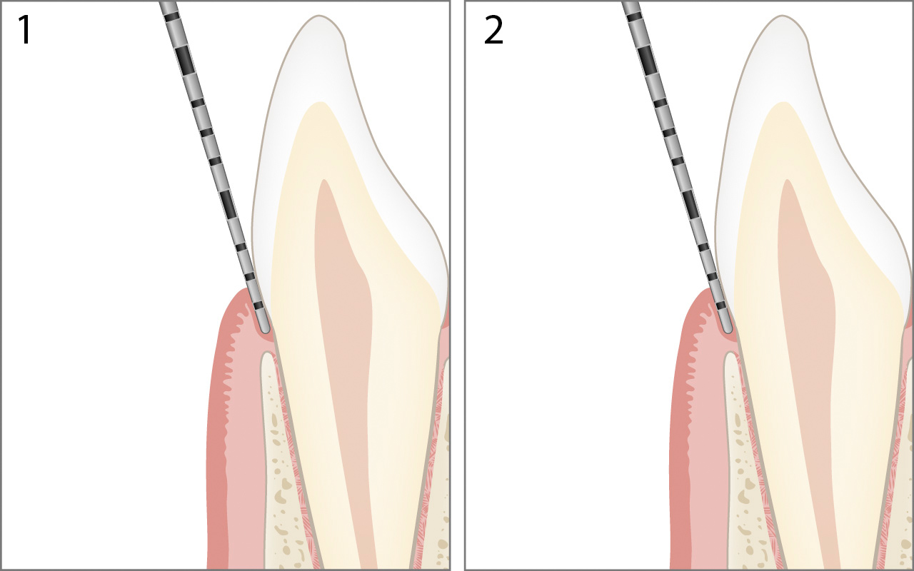 Probing healthy periodontium